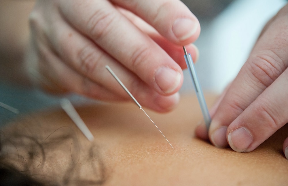 Dry Needling Sanger, TX